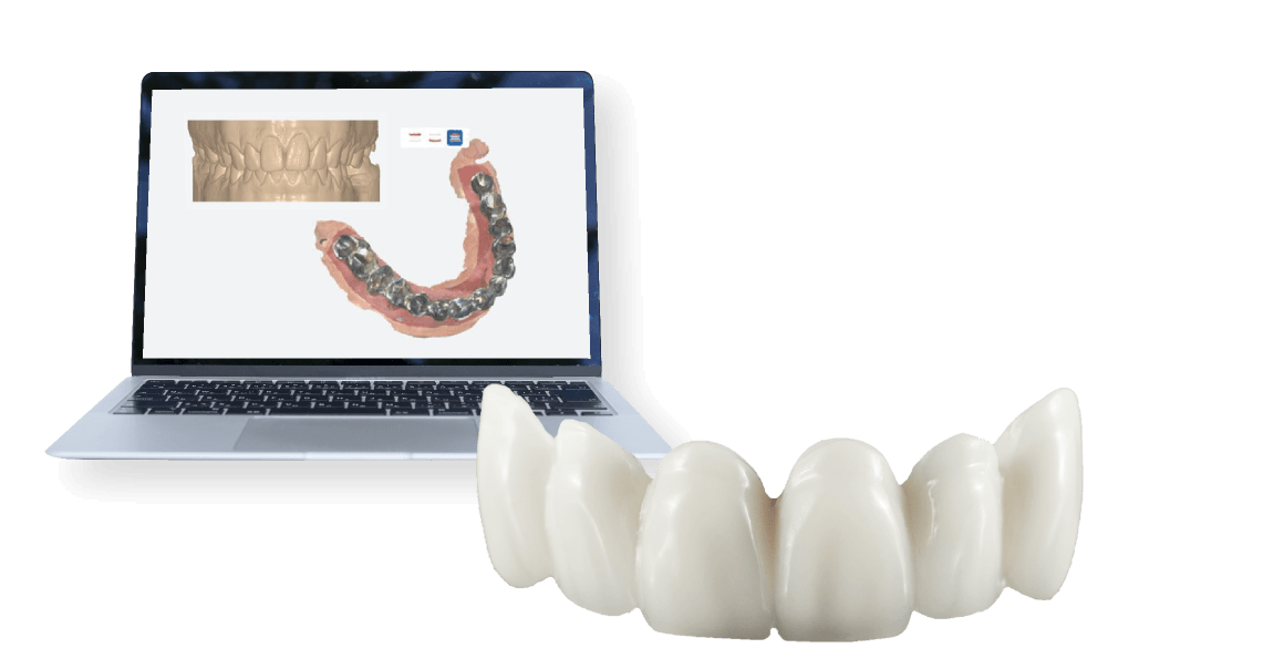フィット感の高い詰め物・被せ物